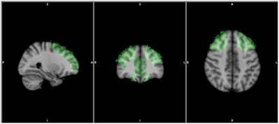 Gray Matter Abnormalities in the Inhibitory Circuitry of Young Binge Drinkers: A Voxel-Based Morphometry Study